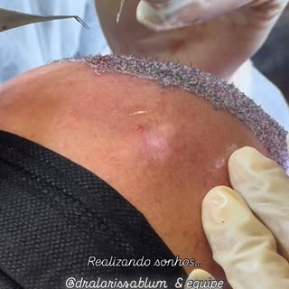 Paciente veio de Curitiba para operar conosco em Ponta Grossa! #tecnicafue #transplantecapilar #dral