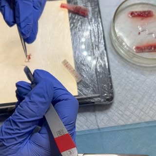 Cirugía de avance o descenso de la primera línea capilar:
✅ Indicada tanto para 🚹 como para 🚺, sie