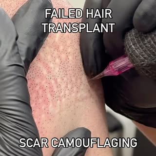 Carefully tackling those old school FUE transplant scars with ARTISTRY and CONFIDENCE 🖊️

My client