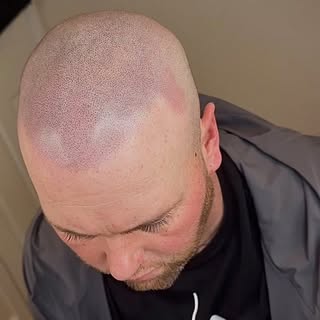 Post Top-Up 🤩 redness will subside by tomorrow

Existing customers have a spook-tacular discount on