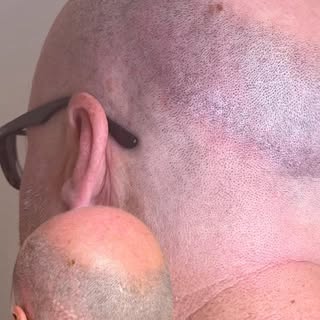 FUE hair transplant scar camouflaging 

Failed hair transplant ❌

We achieved this result over 2 ses