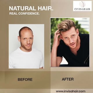 Understanding hair system costs starts with choosing quality, customization, and long-term comfort. 