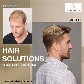Working with an experienced hair replacement specialist can make a major difference in achieving nat