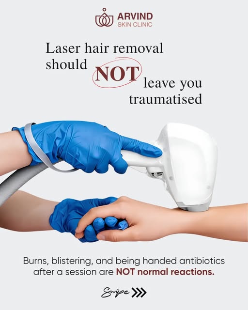Burns and blistering after a laser session are not normal—and you shouldn't be told otherwise.

The 