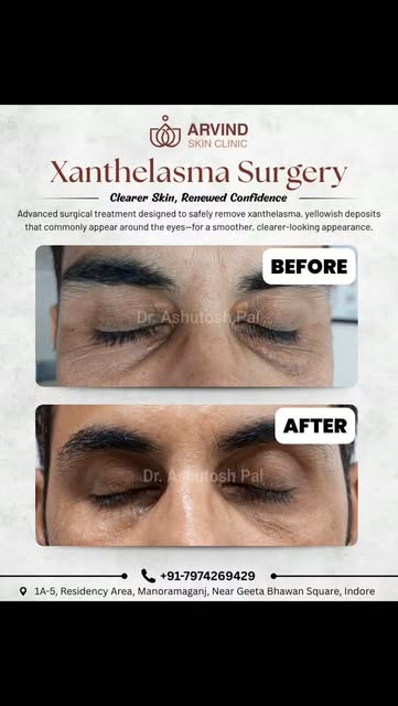 Yellowish patches around your eyes? 👁️✨ That could be Xanthelasma—a common condition caused by chol