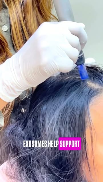Exosome hair treatment is an advanced therapy that supports hair follicles, improves the scalp envir
