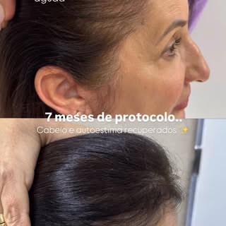 Paciente pós-menopausa, com mudança capilar e queda aguda por emocional. 

Queda não é destino — é s