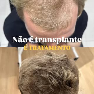 Com o protocolo individual e adequado podemos ter evoluções surpreendentes!! 

Paciente apenas com t