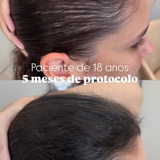18 anos e já estava notando que o cabelo estava mudando.
Como se ele estivesse sumindo…

E como isso