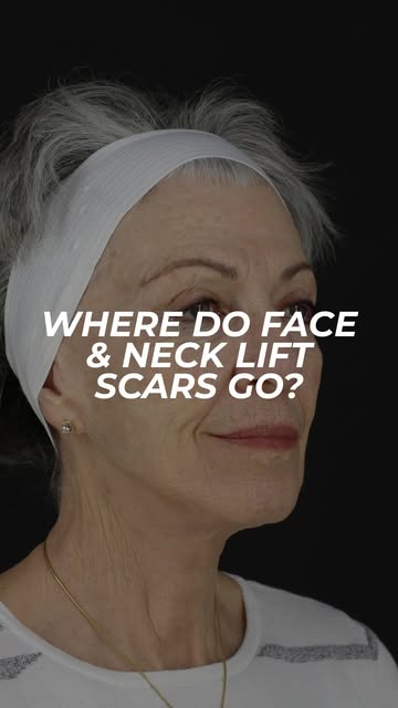 Un facelift, expliqué simplement! Dr Sinno vous montre l’anatomie, les incisions et le principe du l