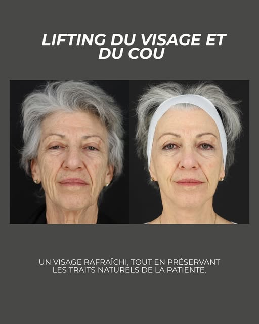 Un lifting ne consiste pas à changer un visage, mais à restaurer ses contours. Ce lifting du visage 