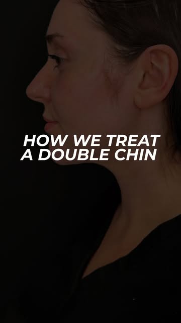 A more defined jawline can make a big difference in someone’s profile. Submental liposuction targets