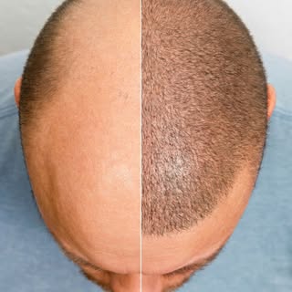 Ihre neue Ausstrahlung beginnt hier!

Eine Haartransplantation bei uns in Reutlingen kann Ihr Ersche