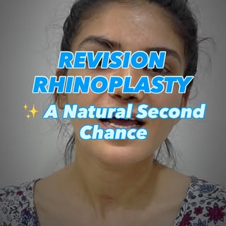 ✨ Revision Rhinoplasty Success Story | Natural Nose Reshaping Results in Ahmedabad ✨

A successful R