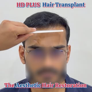 ✨ 8 Months. One Transformation. A Lifetime of Confidence. ✨

From thinning hair to a naturally resto