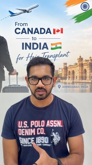 ✨ From Canada 🇨🇦 to Ahmedabad 🇮🇳 for a Hair Transplant — and the results speak for themselves!

