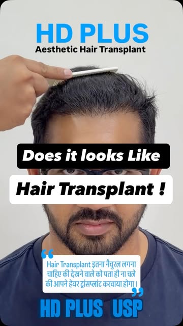 🔥 7 Months Hair Transplant Result | Natural Hairline, Real Confidence

Not every great hair transpl