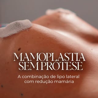 Mamoplastia com resultado natural

A mamoplastia redutora sem prótese pode proporcionar uma transfor