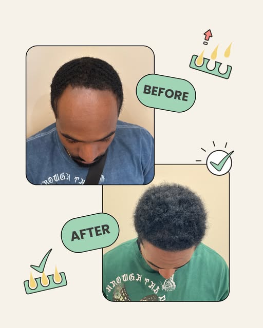 Day one to month nine with just 1,350 grafts 🤯👏

His hairline is already looking fuller and more d