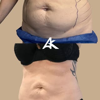Exemple de lipoaspiration haute définition abdominale.  Il y a encore quelques années, sans les tech