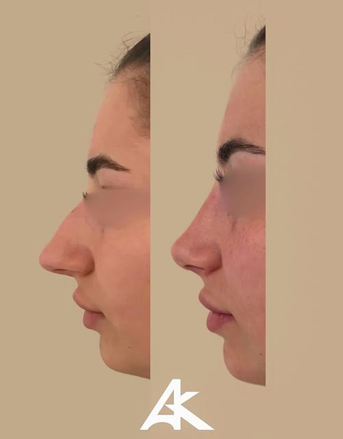 Rhinoplastie avant/ après