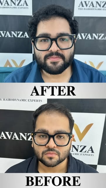 The “Before” tells the story.
The “After” tells you what’s possible. 👀✨

Natural-looking results. A