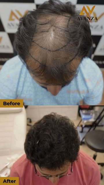 Let the results do the talking. 🤌✨

A sharper hairline.
Natural-looking density.
A transformation t