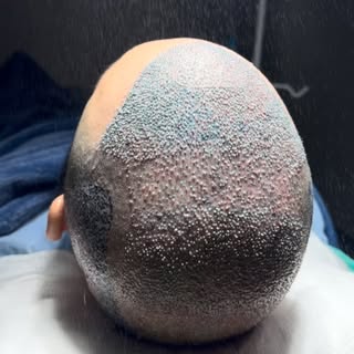 Resultado de mais um Transplante Capilar de sucesso por aqui! 🙌✨

Cirurgia de ontem, paciente jovem