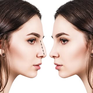 With nonsurgical rhinoplasty, we can help you receive natural results with no downtime. Dr. Nettles 