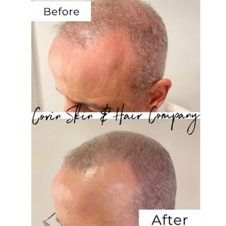 A successful Natural SMP Treatment meeting our client´s expectations.
Thank you for trusting us.✨

N
