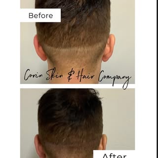 Scars? We got you covered! Life changing results⭐️

NYC📍

#scalpmicropigmentation #micropigmentacio
