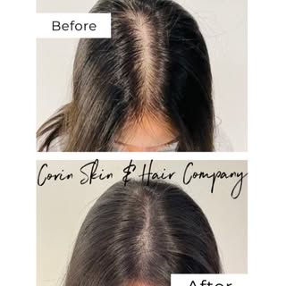 For you women who suffer from hair loss or thinning hair, we can also change your life. Don’t wait a