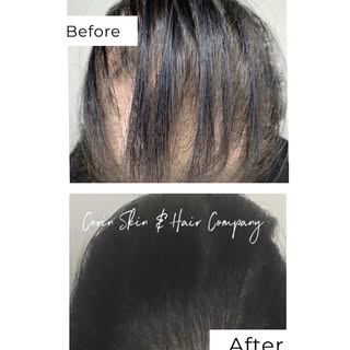 Transforming lives, one scalp at a time. See the difference micropigmentation can make! 🙌🏻✨

NYC �