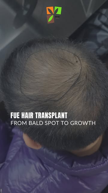 That bald spot you keep trying to hide? 👀 It might be time to give it a little more attention.

Wit