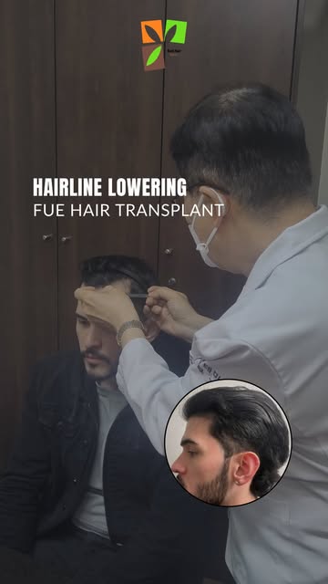 A high hairline can change the way your entire face looks and for some people, lowering it can help 