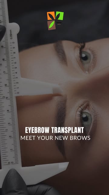Thin, sparse, or uneven brows? Your brows deserve more than just a pencil. ✨

An eyebrow transplant 