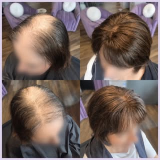Scarring alopecia is just one of the many reasons women experience hair loss. Whether it's caused by