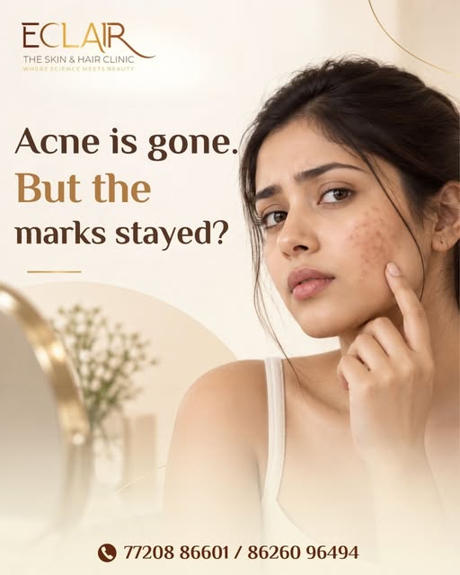 Not every mark left after acne is a scar — pigmentation, redness & texture are different concerns.
 