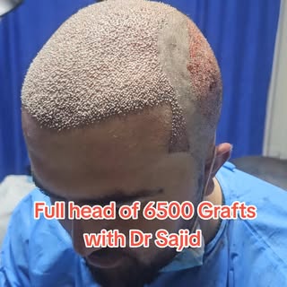 Full head 6500 Grafts | Dr Sajid Amin | Chinese FUE Contact Peshawar Islamabad  03318822666 Kabul 03
