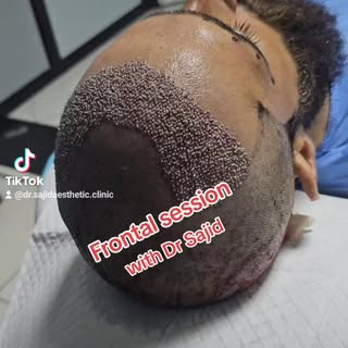 Frontal session