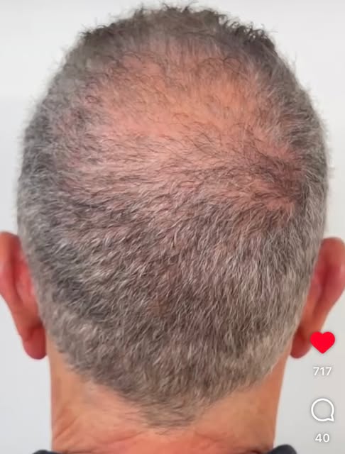 Grey Hair/Dont Care #scalpmicropigmentation #baldsuperman #hairlosshero #smp #nychaircare