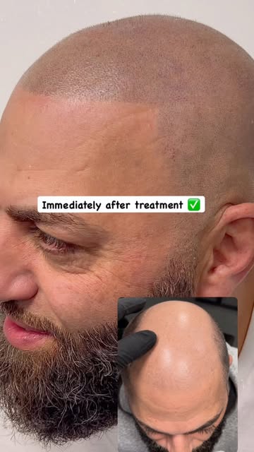 🤫The devil is in details #smp #hairtattoos #hairlosshero #nyc