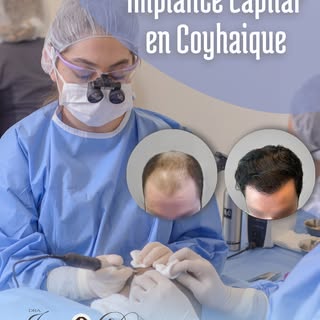 ¡Sí, ya es una realidad! Este mes dimos el puntapié inicial a las cirugías de implante capilar en Co