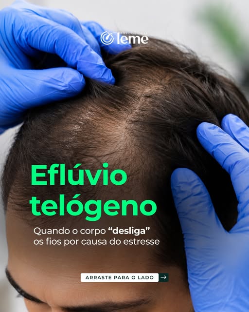 Nem toda queda de cabelo acontece imediatamente após um período de estresse.

O eflúvio telógeno pod