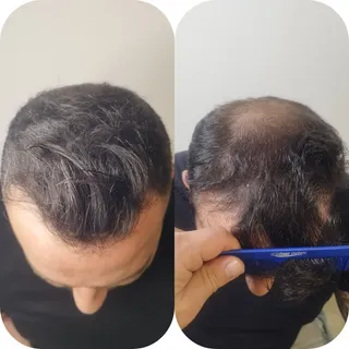 Cambio terminado!!
(Redensificación capilar)🔝😎
Tienes problemas de alopecia?
No dudes en contactar