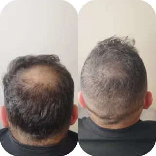 Resultado totalmente natural!!
(Coronilla camuflada)
Consulta personalizada!!
Cambio garantizado
Ind