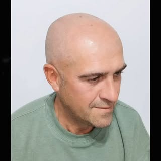 Aquí os dejo  un resumen del proceso de la Micropigmentacion Capilar ✨ 
Donde se pueden apreciar alg