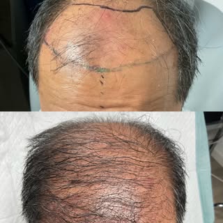 Real results start with the right hair restoration plan✨

This client is already showing early hair 