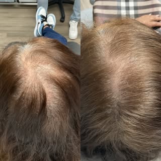 Before ➡️ After
Progress you can see. Healthier, fuller-looking hair with a customized treatment app