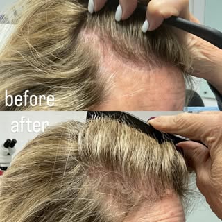 Concerned about frontal thinning?

Dr. Kumar’s customized hair restoration focuses on natural hairli
